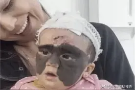 曾经那个做7次整容，改变自己的蝙蝠胎记的女孩，现在怎么样了图片