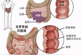 这种“穿肠烂肚”的疾病，极易被误诊为肠胃炎，一旦患上无法治愈图片