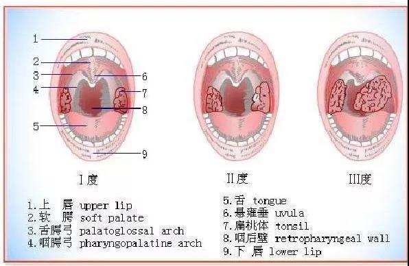 知识科普 |“发热”——带你认识扁桃体的三度肿大