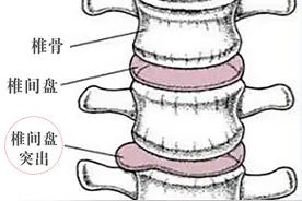腰椎间盘的酸疼腿麻，自己敲打一个穴位就搞定图片