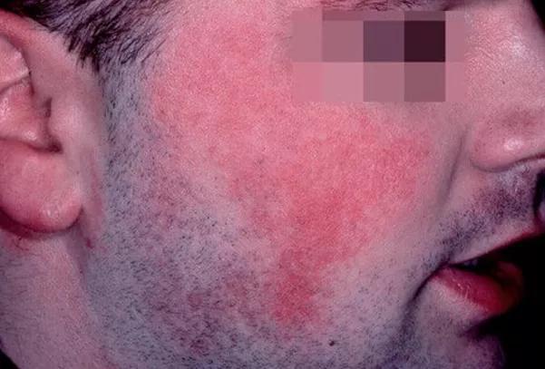 去鸡皮疙瘩鱼鳞