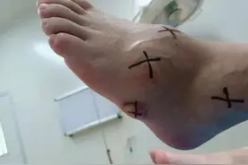 五年前长出痛风石不戒酒，男子相信喝童子尿治痛风？这样做对吗？图片