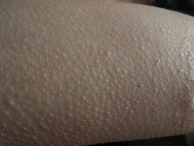 鸡皮肤是由什么造成的