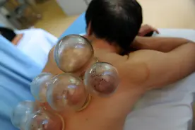 拔火罐时，后背出现的瘀血，是排出的毒素吗？看完涨知识了图片