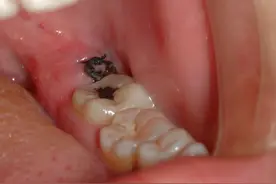 不能治愈的干槽症，到底是怎么回事？拔牙必看图片