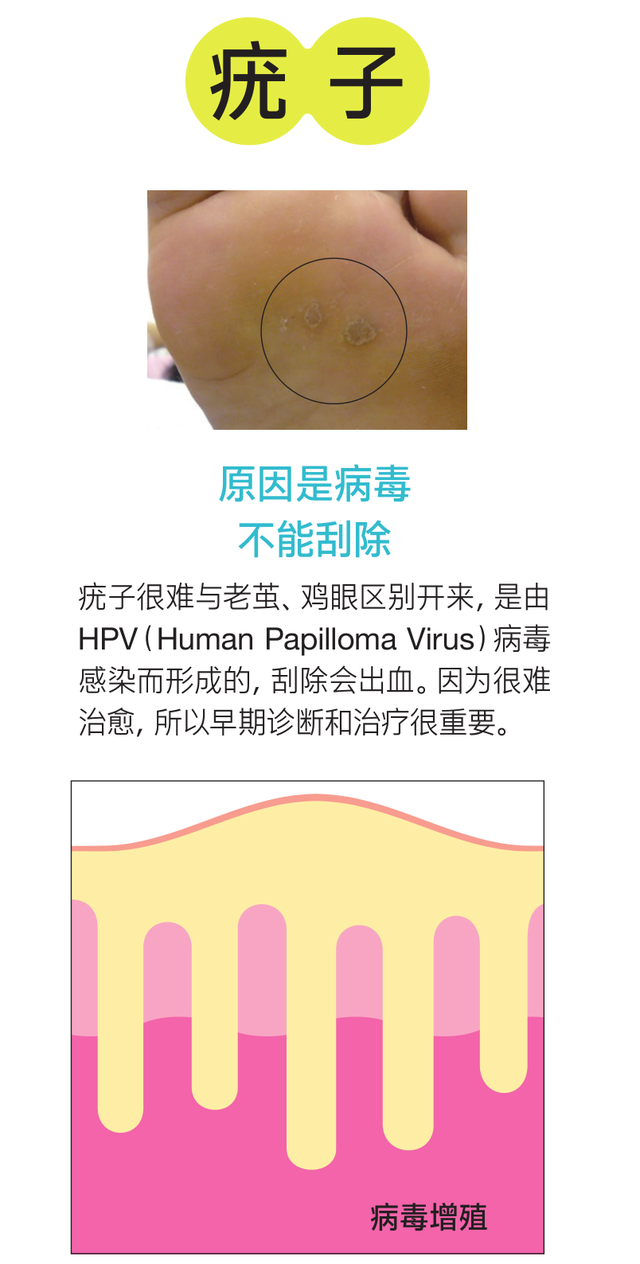 角化过度型足癣脂肪肝