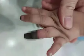 3岁女童手指受小伤，被家人错误包扎，最终被迫截掉坏死部分图片