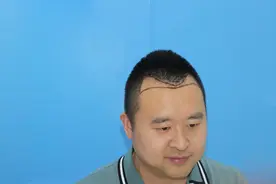 发际线种植效果展示，植发就是这么容易图片