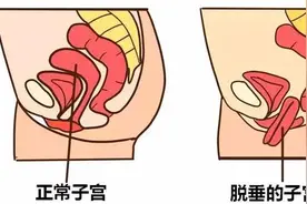 孕产课堂｜产后子宫脱垂，每个妈妈都不能忽视的问题！图片