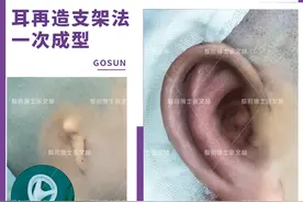 耳再造有哪几种方法？怎么选择手术方式？图片
