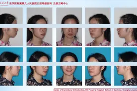 微创正颌：一种小创伤的正颌手术图片