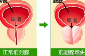 得了前列腺增生怎么办？前列腺增生能否治愈？医生一文为你说清楚图片