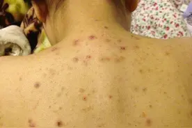 后背经常抠出白色的“小颗粒”，这是什么？教你2招后背干净细腻图片