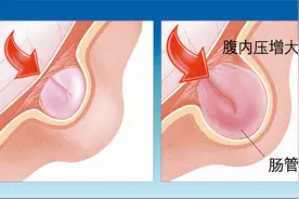 得了“小肠气”需要手术，却碰到新冠疫情该怎么办？图片