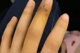 女子下楼扔垃圾，一个动作导致手指肌腱断裂！随后将这段经历画成简笔画图片