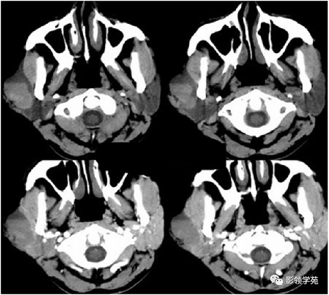 腮腺角化型鳞癌