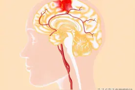 家里老人突发脑溢血，懂得急救很重要：4个步骤记清楚，能救命图片