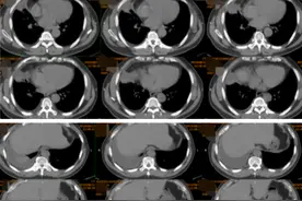 56岁男子肺部异影伴胸腔积液进展蹊跷，两段反转性病史揭迷雾图片