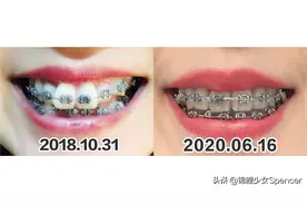 成为牙套妹20个月，土味女孩变身精致girl？图片