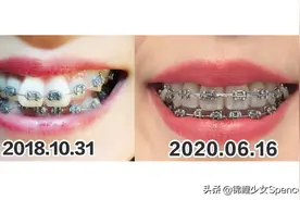成为牙套妹20个月，土味女孩变身精致girl？图片