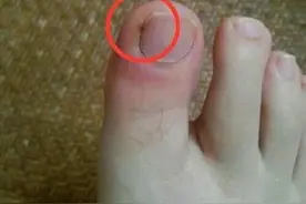 脚趾甲两侧总是镶嵌到肉里，怎么办？方法很简单图片