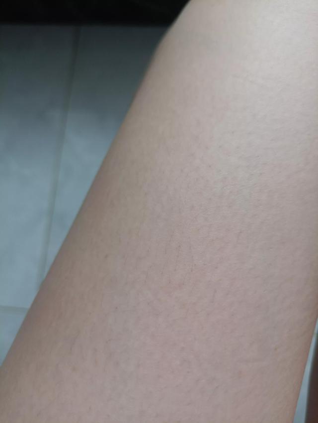 维A酸乳膏去鸡皮肤有用吗