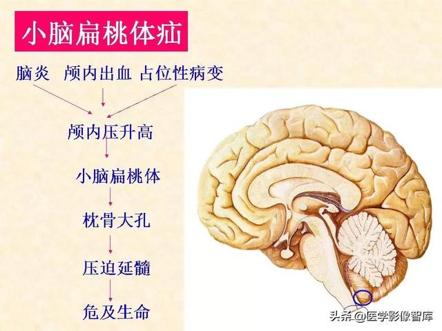 脑干、小脑及间脑解剖
