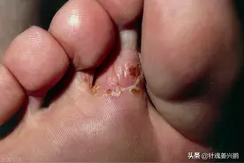 “脚气”真菌怎么才能根治？3个人人实用的方法，彻底治好不复发图片