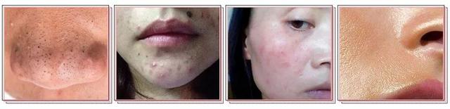 6娆惧崠鐤簡鐨勯櫎铻ㄧ殏姣旀嫾锛侀櫎铻ㄧ殏鐪熺殑鑳介櫎铻ㄥ悧锛熻繕鏄蹇芥偁浜嗭紵