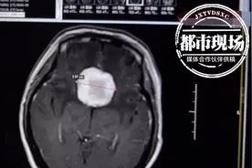 女子左眼近乎失明，以为是白内障！几个月后一检查：脑肿瘤图片