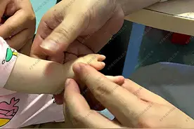 手外周海定：宝宝蟹钳样多指，如何治疗才能保住孩子的手功能？图片