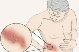 “蛇缠腰”长满一圈就会死人？它有没有传染性，会复发吗？图片