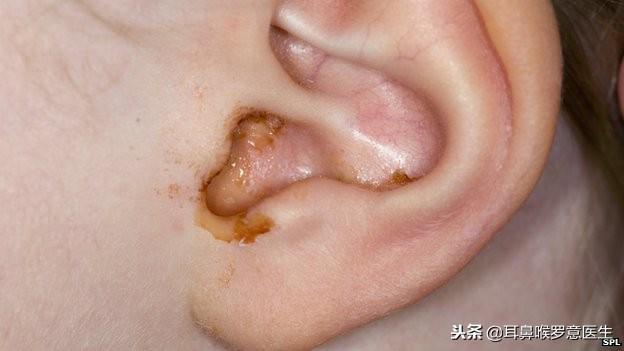 为什么会有干耳和油耳然而如果耳屎蓄积过多,则可能形成"耵聍栓塞"