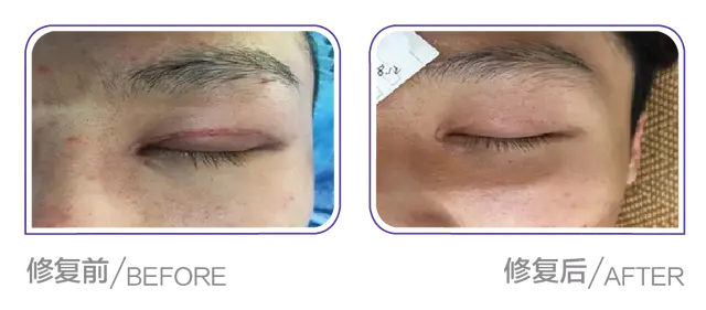 脂溢性角化做激光会留疤痕吗