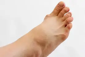 痛风都有哪些好发部位？脚背痛是痛风发作了吗？图片