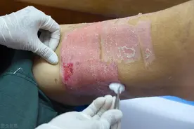 植皮术后有哪些注意事项呢？图片