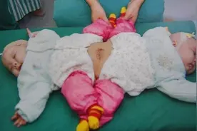 国内首例成功分离的连体双胞，如今10年过去，她们现状令人感叹图片