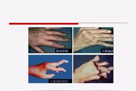【医学科普】详解类风湿性关节炎图片