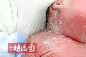 心疼！女婴刚出生就满身“鱼鳞”，皮肤干枯如老人图片