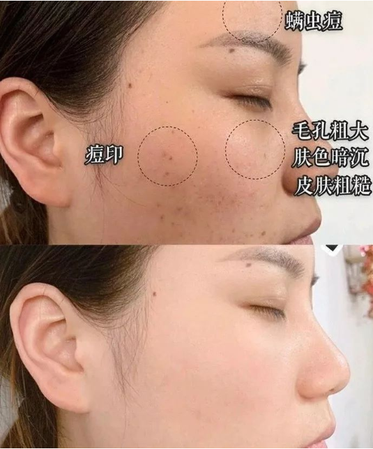 洗面奶中这2种网红护肤成分叠加使用：温和清洁+除螨杀菌＞2？