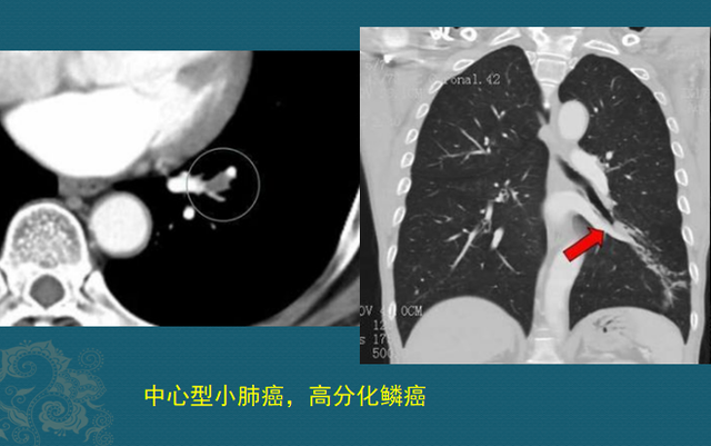 肺癌病理非角化型鳞癌