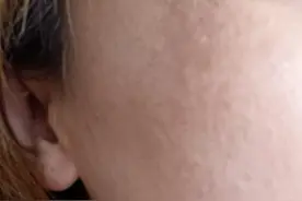 祛斑路上第一天，我得记录一下子图片