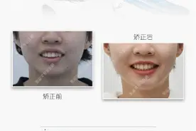 福州牙齿矫正｜针对龅牙嘴突案例，牙医在正畸时会考虑哪些因素？图片