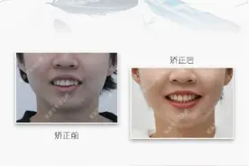 福州牙齿矫正｜针对龅牙嘴突案例，牙医在正畸时会考虑哪些因素？图片