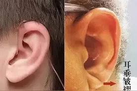 耳朵有折痕，就是冠心病？会发生心肌梗死吗？医生辟谣：正确解读图片