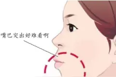 龅牙、嘴突也能矫正吗？图片