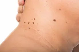 脖子周围“冒出”很多小肉球，不痛不痒是皮肤病吗？看医生怎么说图片