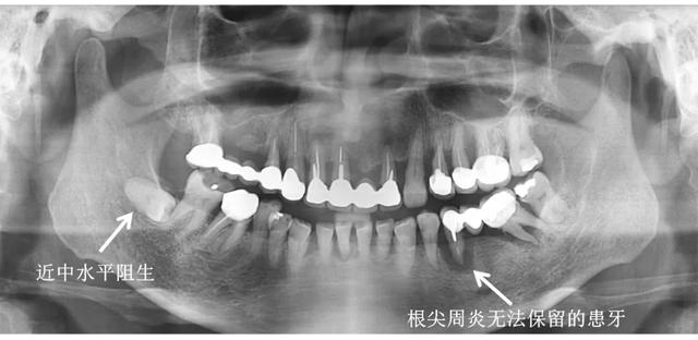 小伙拔牙10天后脑出血死亡!拔牙前后的这些忠告,一定要看