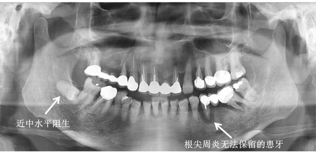 小伙拔牙10天后脑出血死亡！拔牙前后的这些忠告，一定要看