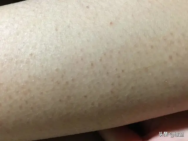 武汉皮肤科汗孔角化